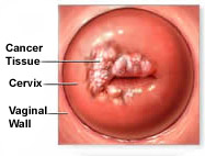 Cervical Cancer