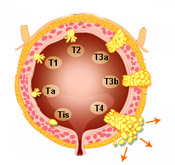 Bladder Cancer