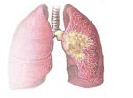 Lung Cancer 