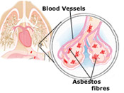 Mesothelioma