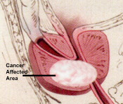 Prostate Cancer