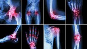 Facts & Myths about Arthritis