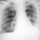 Aspiration pneumonitis