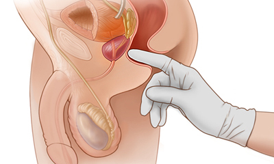 Digital Rectal Exam