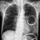 Lung Abscess