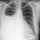 Pleural effusion