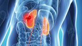 Kidney Diseases