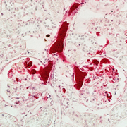 Glomerulonephritis