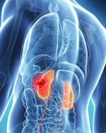 Kidney failure