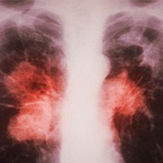 diagnosis of tuberculosis