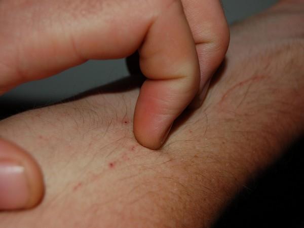 How to beat eczema itch?