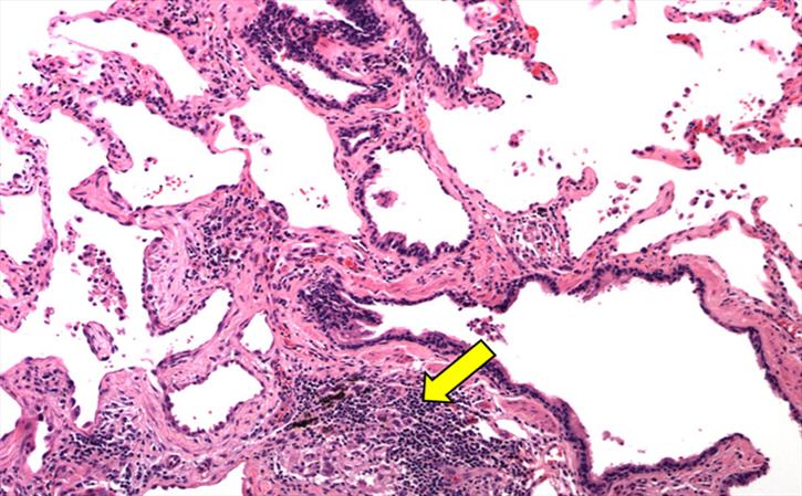 Exposure to allergens can cause Hypersensitivity Pnuemonitis