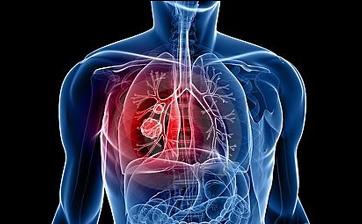 Respiratory Failure, a life-threatening condition